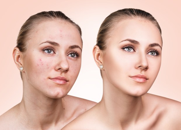 Comparison portrait of young girl with problematic skin before and after treatment